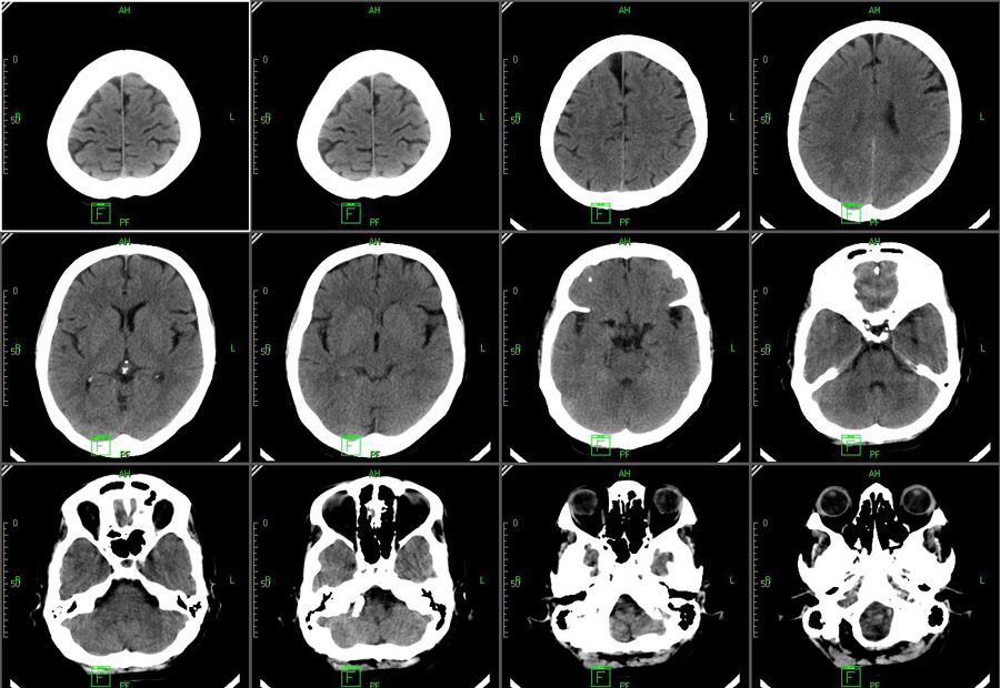 ПЭТ/КТ диагностика головного мозга с метионином - Сlinica